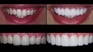 Porcelain Dental Veneer Placement San Antonio