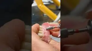 2 Dentures from Moscow | Inside a High-End Dental Lab #dentalprosthesis #prosthetics #dentures
