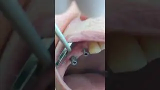 3 tooth implant bridge