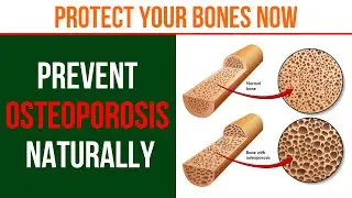 10 Natural Ways to Prevent Osteoporosis and Strengthen Bones