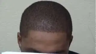 Black African FUE Hair Transplant After Hairline Restoration Surgery Dr. Diep www.mhtaclinic.com