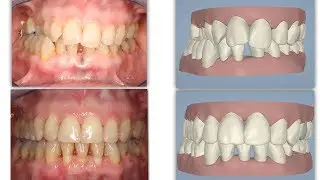Amazing Invisalign Crossbite Orthodontic Treatment & incisor extraction (without braces)