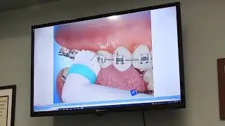 Braces instructions