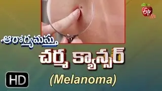 Aarogyamastu | Melanoma | 18th October 2016 | ఆరోగ్యమస్తు