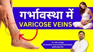 Varicose Veins in Pregnancy - Causes, Treatment & Tips - Pregnancy me Varicose Veins Ho To Kya Kare?