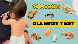 Baby Eczema|Baby allergy|Food allergy|Allergy test|Top 8 allergens|How to take care sensitive skin