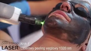 Laserowy peeling węglowy Black Doll - YASUMI Carbon Peel
