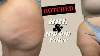 Plastic surgery disaster | Fixing a BOTCHED BBL & Hip Dip Filler