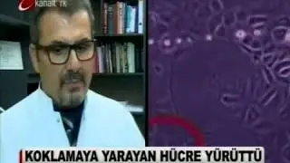 Felç Hastalığına Burundan Alınan Kök Hücre İle Tedavi