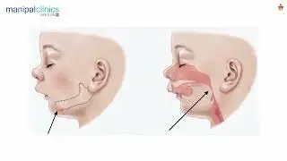 Mouth Breathing & Snoring Kids | Dr. Sushmitha Explains the Real Reason | Manipal Clinic Indiranagar