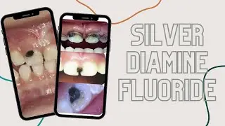 Silver Diamine Fluoride #shorts