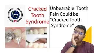 Dr Rudra Mohan | Unbearable Tooth pain could be CRACKED TOOTH SYNDROME (CTS)!