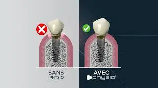 La performance en implantologie avec iPhysio&reg;