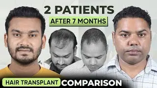 Hair Transplant in Delhi (HX-AROD) | Best Results & Cost of Hair Transplant in Delhi