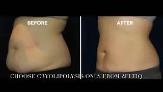 Coolsculpting by ZELTIQ