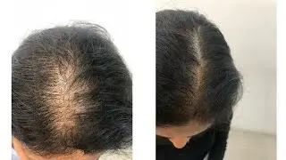 How To Control Hair Fall for Men And Women|| 10 RemediesTo Grow Hair Faster Naturally|| Reduce Loss
