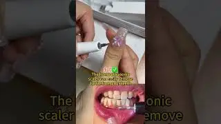 Ultrasonic Tooth Cleaner for Family #oralhygiene