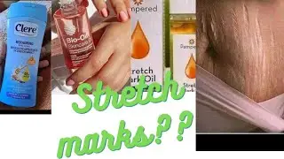 Most Affordable & Effective Skin Repair Products for Stretch marks and Scars
