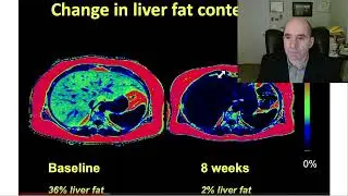 Roy Taylor diabetes lecture, fatty liver & weight loss