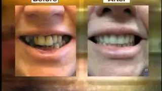 Mini dental implants are a great way to improve your smile