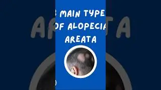 3 MAIN TYPES OF ALOPECIA AREATA (HAIR LOSS) | #edukasyongpangkalusugan