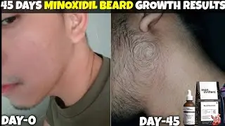 45 days man matters beard growth results | man matters beard growth kit review | minoxidil beard|