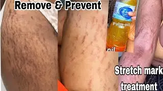 stretch mark removal / how to remove stretch mark how to get rid of stretch marks Stretch mark