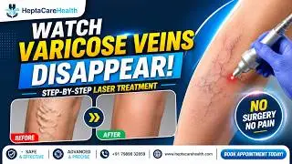 Step-by-Step: HeptaCare&rsquo;s Laser Varicose Vein Removal 💡