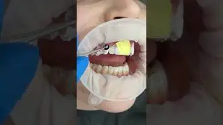 Replacing old bonding with 8 direct composite veneers ✨❤️