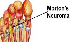 Montgomery Foot Care Specialists: Neuromas