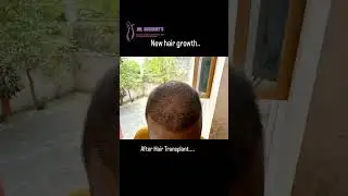 Hair Transplant Result... #plasticsurgery #hairtransplant #hair #result #happy #patient #drsushrut