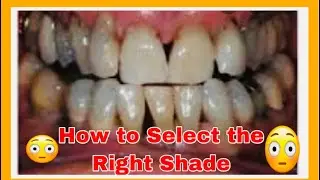 SHINY SMILE Veneers | How to Select the BEST Shade