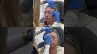 Subtle Botox Results | Physician-Led Aesthetics in Atlanta