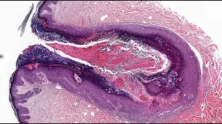 A Rare Case Presentation of Warty Dyskeratoma Involving Multiple Adjoining Follicles