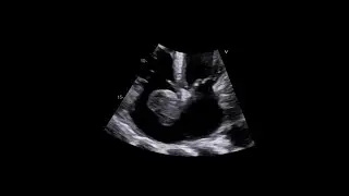 Primary Cardiac Synovial Sarcoma