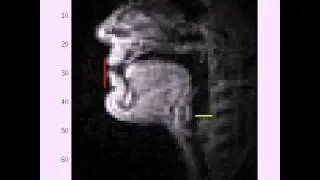 Tracking of the front-most edge of the lips and the top of the larynx