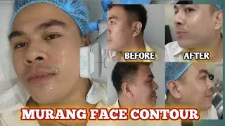 FACE CONTOURING ( HIFU) FIRST TIME KO !!| Mark Mergais