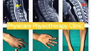 Cervical Myelopathy | Hirayama Disease | Hand Rehabilitation | Dr.Shaikh #cervicalmyelopathy