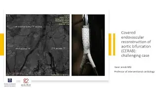 Covered endovascular reconstruction of aortic bifurcation (CERAB): challenging case