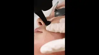 Laser Prep You Shouldn't Skip