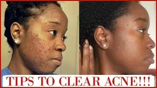 Tips For Clear Skin + What Caused My Acne + All About Retin-A!!! Q&A