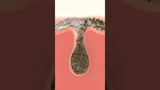 This is how clogged Hair follicle get cleaned with disinfectant spray 🧑&zwj;⚕️