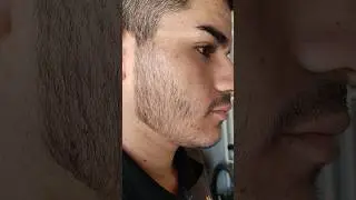 1 ANO de tratamento MINOXIDIL (evolu&ccedil;&atilde;o) #barba #minoxidil