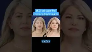 BEST procedure to restore the volume in your face #plasticsurgery #beauty #fattransfer