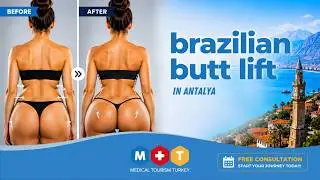 Brazilian Butt Lift (BBL) in Turkey | Natural Curves with Fat Transfer