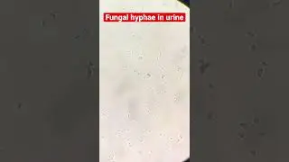 Fungal hyphae in urine sample under microscope (40xview)