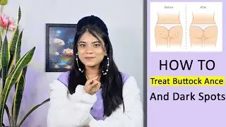 কালো দাগ ফুসকুড়ি পদ্মকাটা ঠিক করার সহজ উপায়how to treat buttocks acne and dark spots