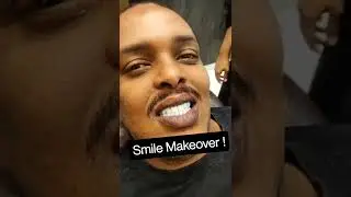 #SmileMakeover #SmileDesign #Dentist #HollywoodSmile