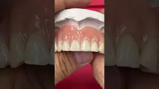 Over denture