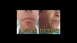 Tirando Barba Na Cera Quente
